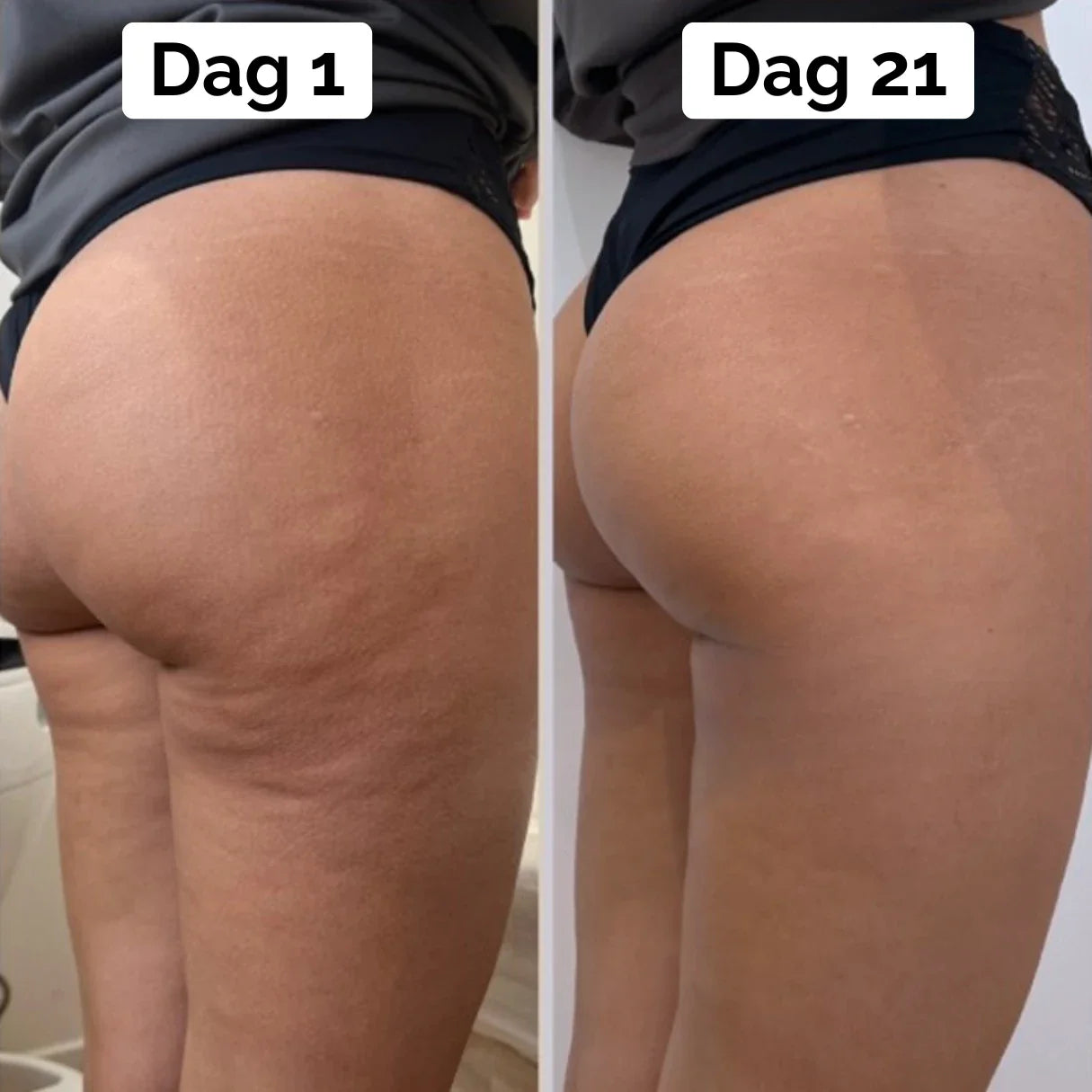 BodySculp 2.0 - Effektiv mod appelsinhud og fedtdepoter