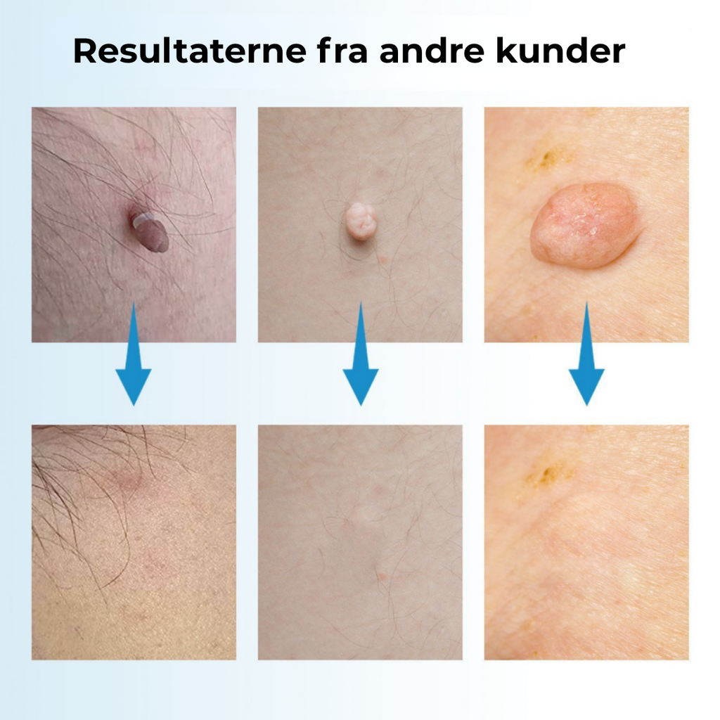 SkinEase™ Pen – Pretty fjernelse af hudmærker!