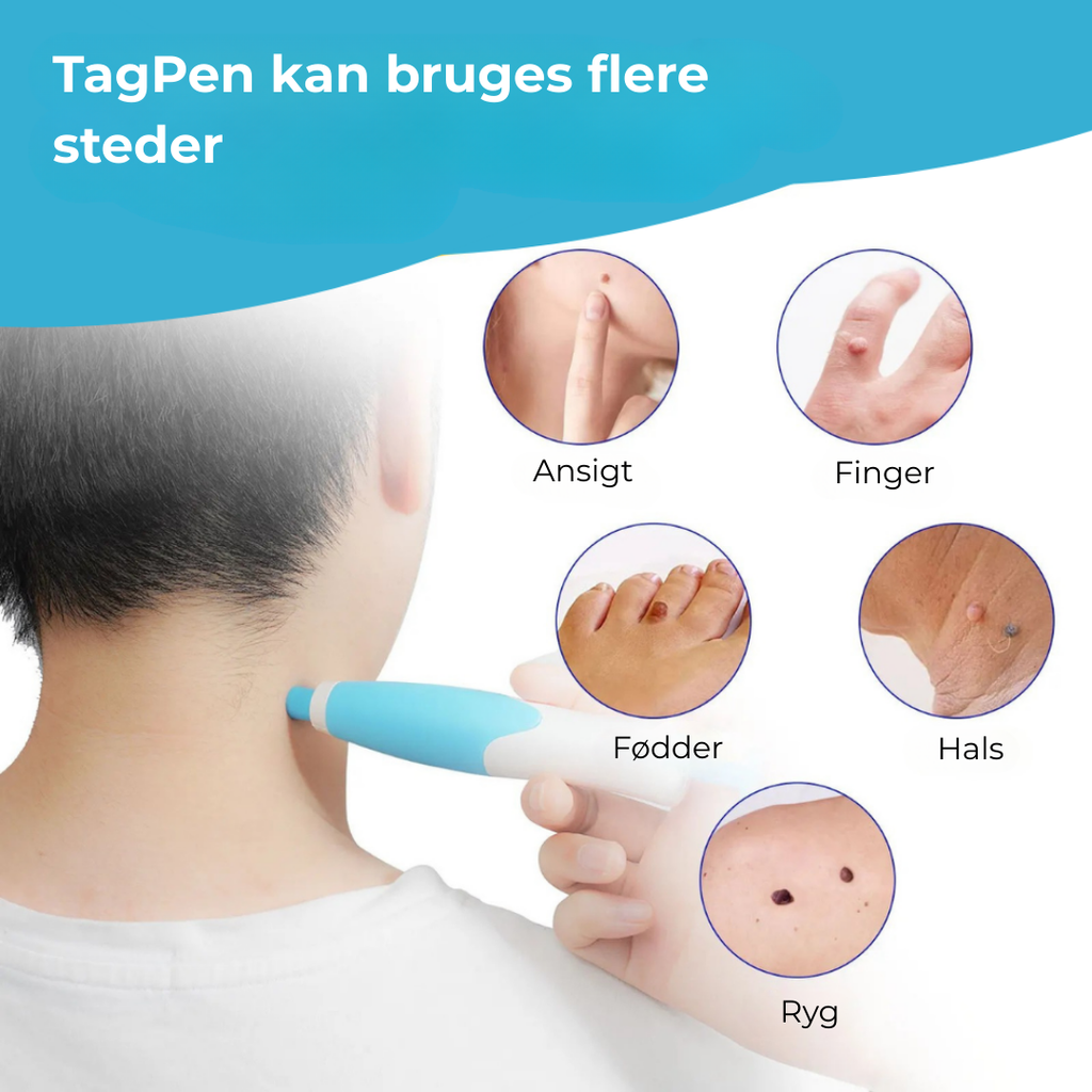 SkinEase™ Pen – Pretty fjernelse af hudmærker!